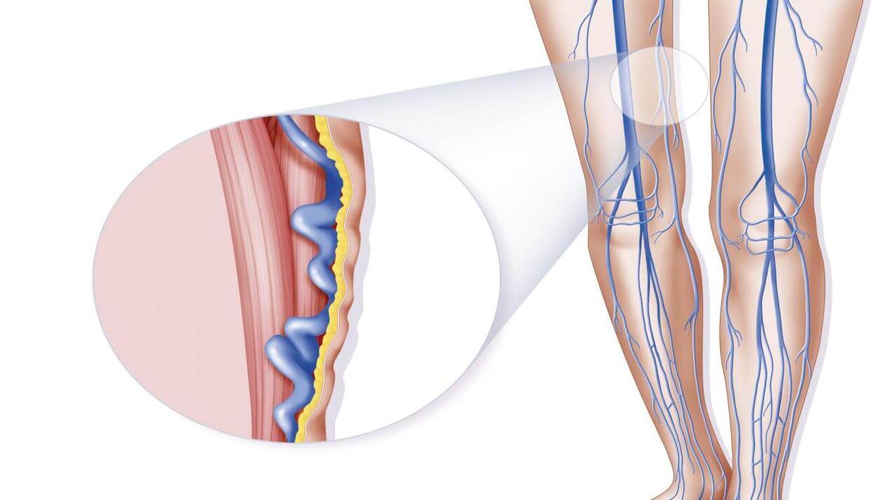 Causas das varices